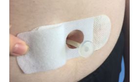 Medicina ace stopper 10fr 30mm